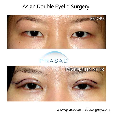 Double Eyelid Surgery (Asian Eyelid Surgery) in New York