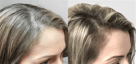 Nutrafol-before-and-after- | Reactive Hair