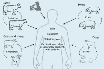 Brucellosis symptoms - Medical Zone