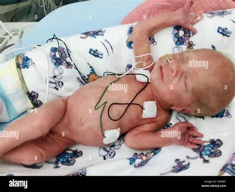 Premature baby 30 weeks hi-res stock photography and images - Alamy