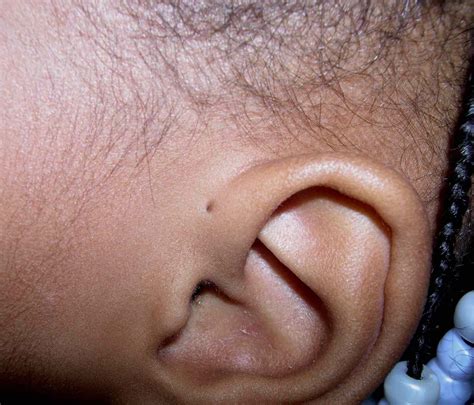 Hole in Ear: What to Know