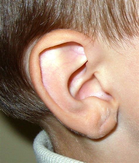 Ear Dimples – Creases and Railroad Track Sign – Clinical Eye Openers