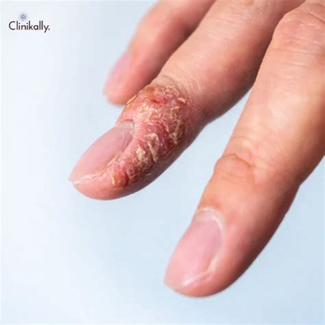 Eczema Flare-ups: Treatment, Causes and Home Remedies | Clinikally