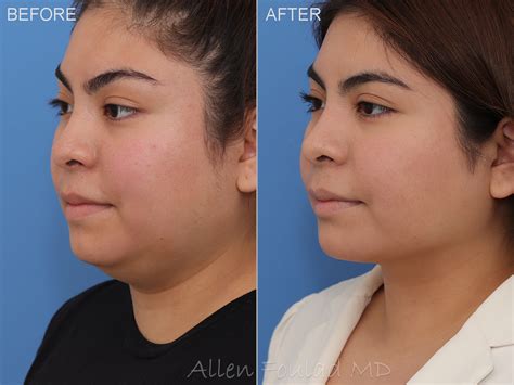 Face Liposuction Before And After