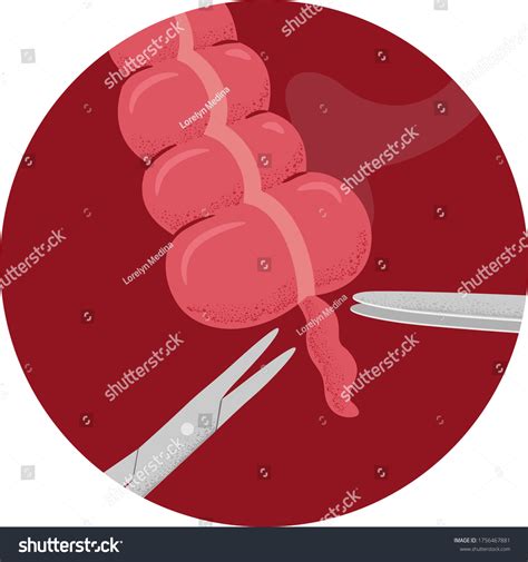 Illustration Appendectomy Surgery Removing Appendix Appendicitis Stock ...