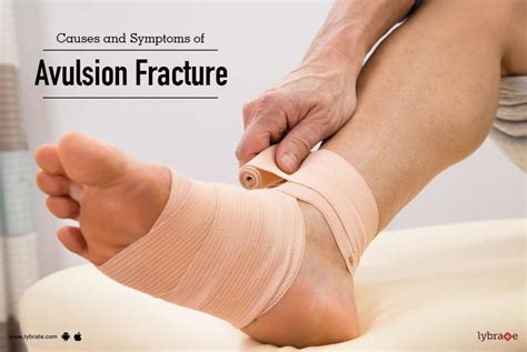 Causes and Symptoms of Avulsion Fracture - By Dr. M.Kaushik Reddy | Lybrate