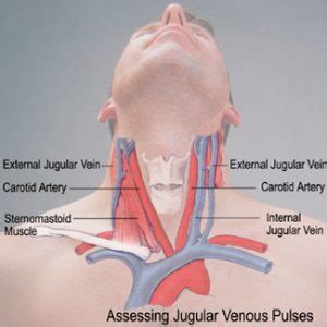 Jugular Venous Pulse (distention) - Definition, Causes, Location ...