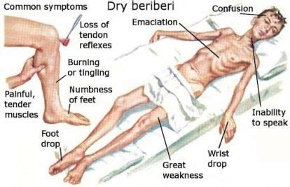 Thiamine Deficiency In Alcoholism | Rehab Guide