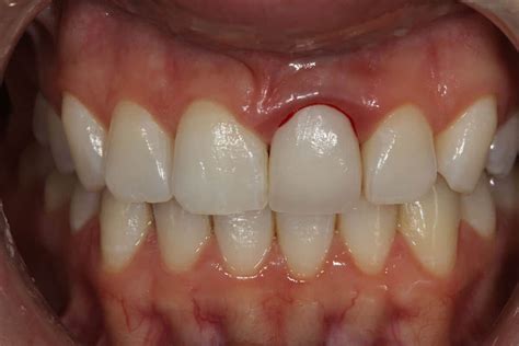 Bleeding After a Dental Crown | Dr. Scott Froum | Midtown NYC