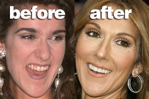 Celebrities With Fake Teeth | Celebrity plastic surgery, Celebrity teeth, Bad celebrity plastic ...