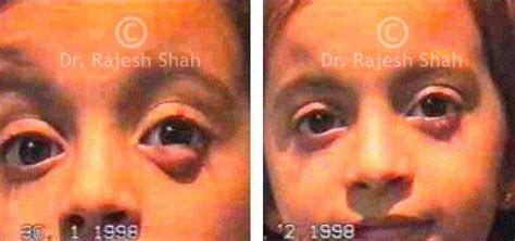 Best Homeopathic Treatment for Chalazion I Effective Health Tips for Patients to Follow
