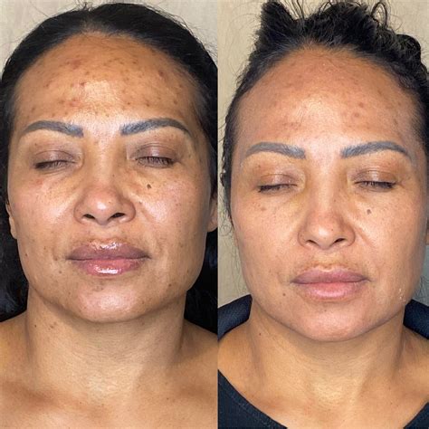 Microdermabrasion Before and After (Results + Pictures) - the daily glimmer