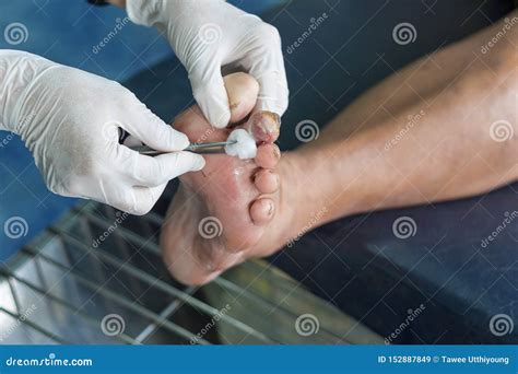 Diabetes foot ulcers stock image. Image of foot, muscle - 152887849