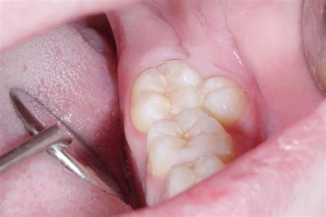 What Is Hyperdontia (Extra Teeth) & What To Do About It