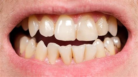 Tartar Vs Teeth Stains: What's The Difference | OnlyMyHealth