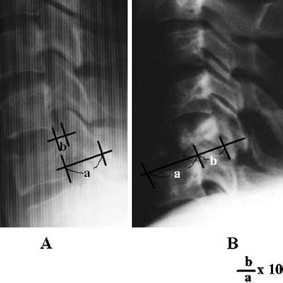 The retropulsion of bone a at the vertebral body level in a burst... | Download Scientific Diagram