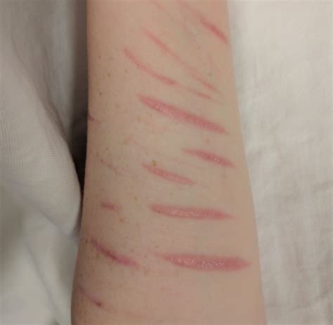 Self Harm Scars Wrist