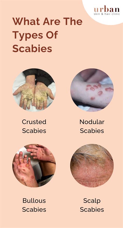 Nodular Scabies