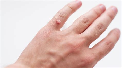Wart Treatment and Removal - Toronto Dermatology Centre