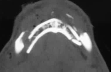 Mandibular Fractures Workup: Imaging Studies, Diagnostic Procedures, Other Tests