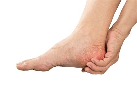 Gout in Heel - What Are the Symptoms and Treatments?