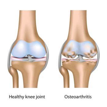 PRP Injections for Knee Osteoarthritis – Howard J. Luks, MD