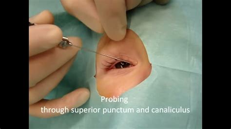 Lacrimal system probing in Children. Dr. H. Aral - YouTube