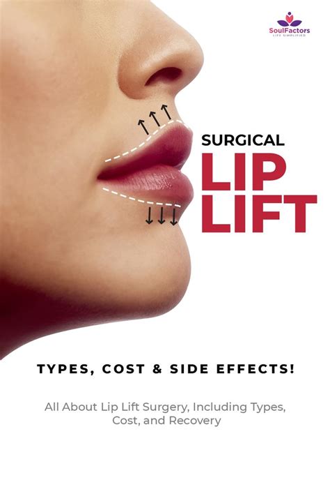 Surgical Lip Lift - All About Lip Lift Surgery, Including Types, Cost, and Recovery! | Lip ...