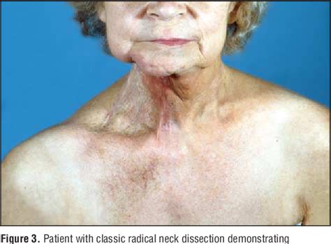 Figure 1 from Neck Dissection: An Operation in Evolution | Semantic Scholar