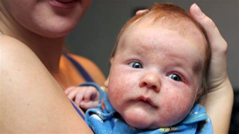 All About Baby Eczema: Causes, Symptoms, Treatment, and More