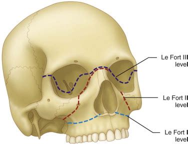 Maxillary Fracture Classification