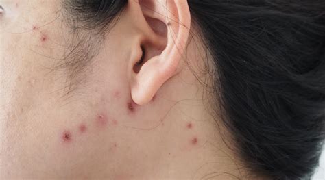 Chicken Pox Scars - Treatments and Prices in Singapore