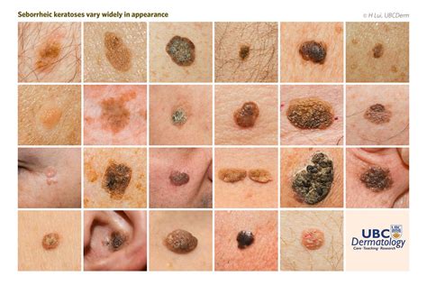 Seborrheic Keratosis Vs Wart