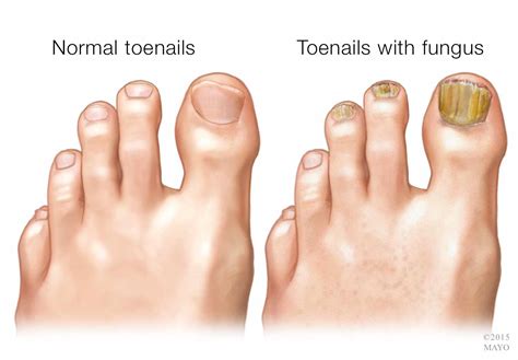 Why is nail fungus contagious and how to prevent it? - Bonum.lt