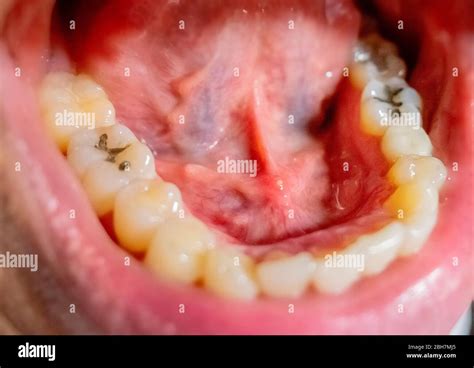 The Sublingual Gland stone disease in mouth Stock Photo - Alamy