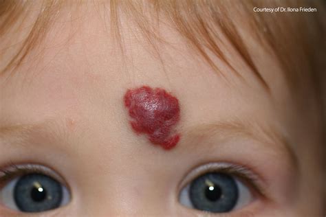 Advice for Parents Regarding Hemangiomas: Time to change our approach in Pediatrics? - All ...