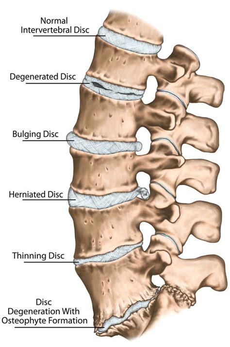 Slipped Disc in Dogs: Signs, Causes, Treatment and Prevention