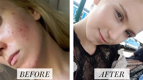 Woman's Before and After Accutane Photos Go Viral on Reddit | Allure