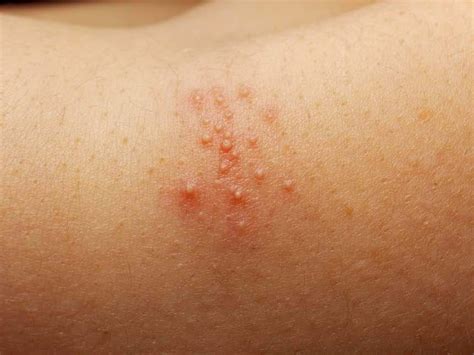 How to treat Groin Rashes: The rash is known to often affect areas of the...