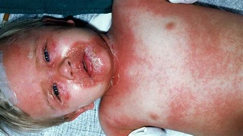 Scalded Skin Syndrome (SSS): Symptoms, Causes, and More