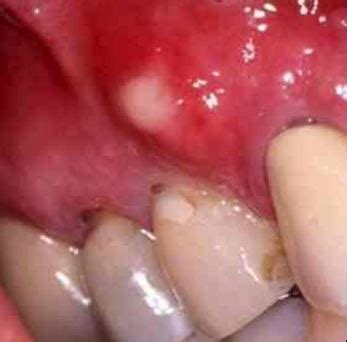 White Spots on Gums, on Baby, Painful Small White Bumps, Patches, Dots above Tooth Treatment