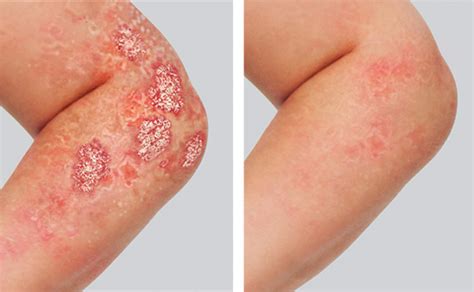 Plaque Psoriasis Pictures Before & After HUMIRA® (adalimumab)