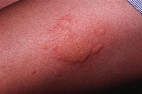 What Are Hives The Common Skin Condition That Gives Y - vrogue.co
