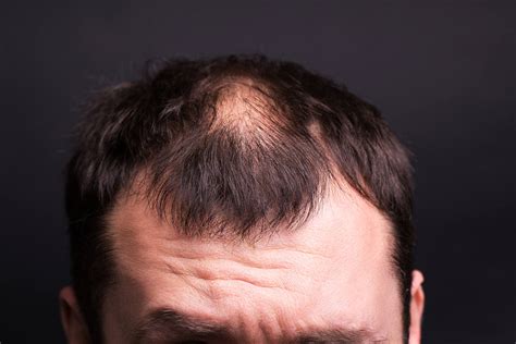 Thinning Hair: 9 Causes, Treatment & Prevention | Elithair