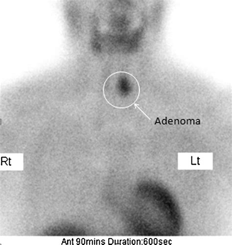 Parathyroid Imaging and Localization Using SPECT/CT: Initial Results | Journal of Nuclear ...