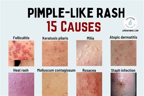 Pimple-like Rash: 15 Skin Bumps That Look Like Pimples