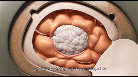 Brain Tumor Surgery Video