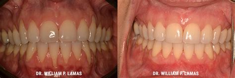 Gum Surgery Before And After