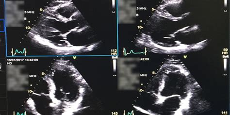 Stress Echocardiogram (Stress Echo) - HeartWest