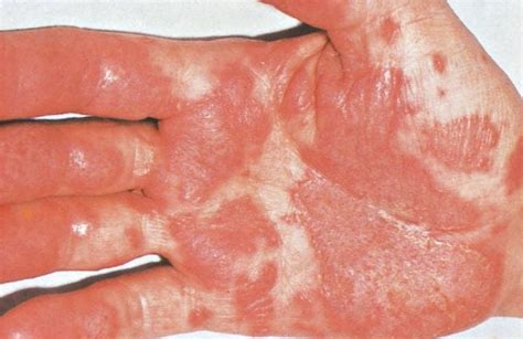 Image: Keratoderma Blennorrhagicum (Palm) - MSD Manual Professional Edition